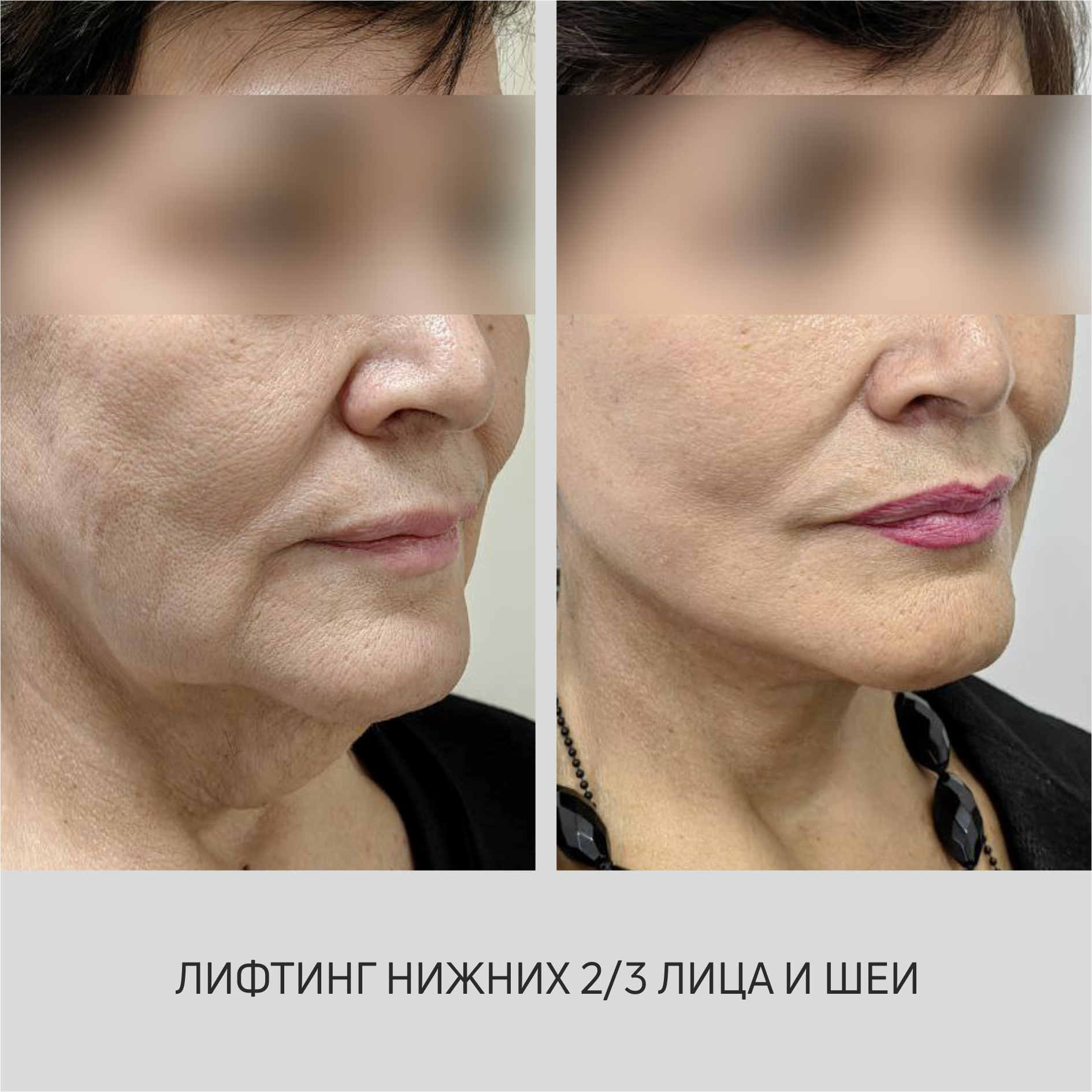 Фото до и после - Пластический хирург Зарина Асланбекова
